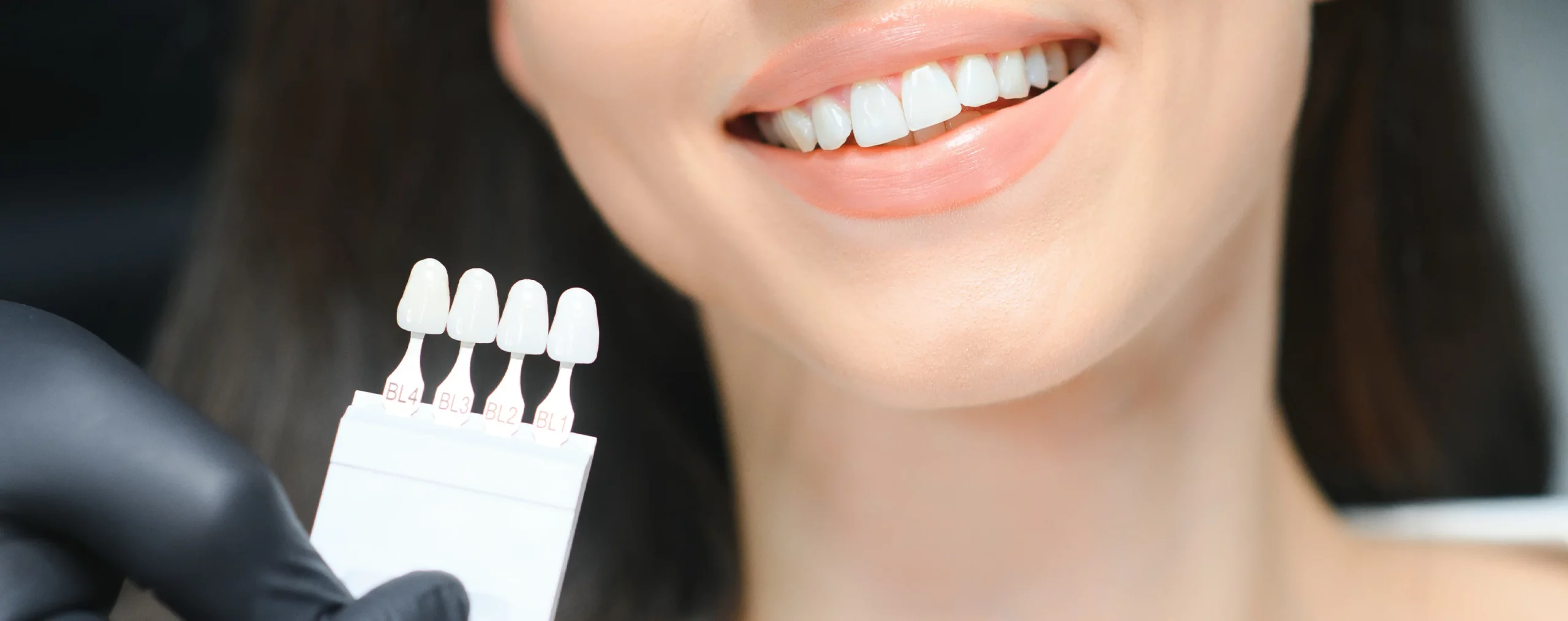 Veneers in Bern: Perfektes Lächeln für Alltag und Anlässe